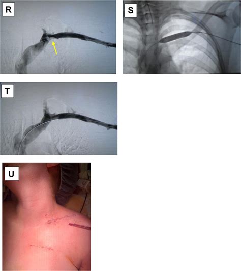 Hybrid Paraclavicular Decompression for Venous Thoracic Outlet Syndrome with Primary ...