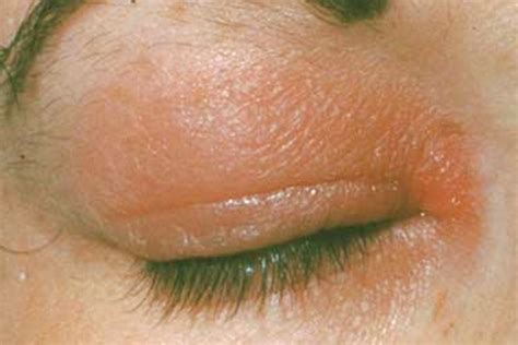 Rash on Eyelid | Medical Point