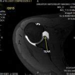 Mr Arthrogram Shoulder 的图像结果