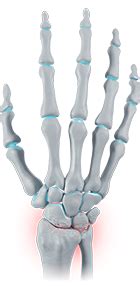 Arthrosis of the wrist – Ailments - Bort