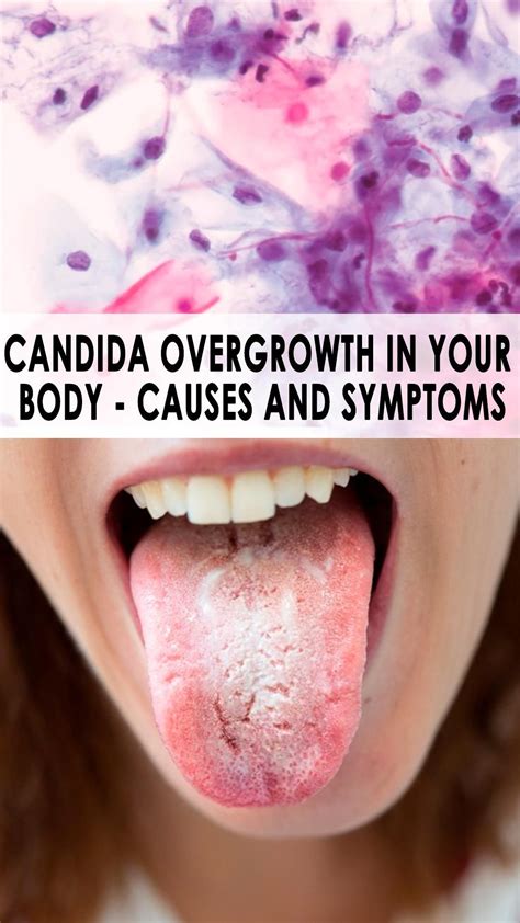 Best 13 Candida Overgrowth In Your Body: Causes and Symptoms – Artofit