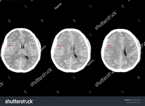 Blood Clot In Brain Due To Accident