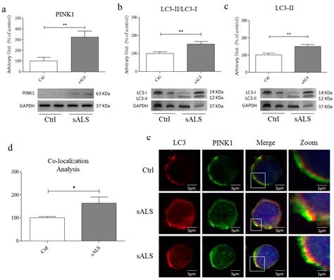 Lysosomes Dysfunction Causes Mitophagy Impairment in PBMCs of Sporadic ...