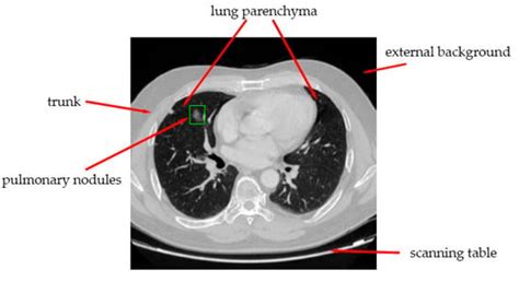 Segmentation of Lung Nodules Using Improved 3D-UNet Neural Network