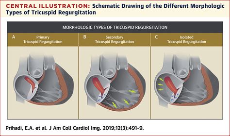 Morphologic Types of Tricuspid Regurgitation: Characteristics and ...