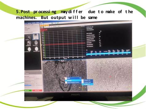 CSF Flow Study MRI 的图像结果