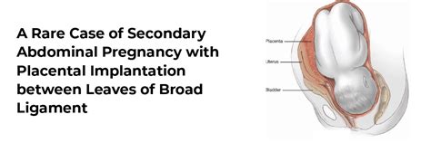 A Rare Case of Secondary Abdominal Pregnancy with Placental ...