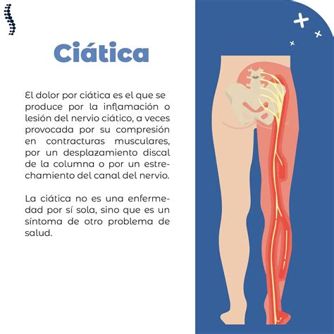 ¡Qué Dolor! Descubre Cómo Aliviar La Ciática De Forma Efectiva – WEOS