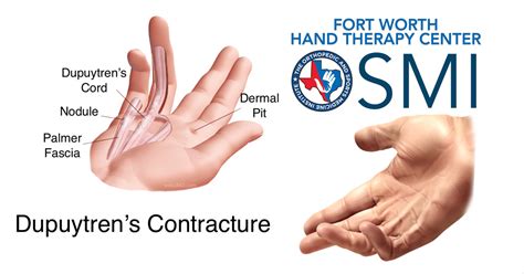 Dupuytren's Contracture Topical Treatment at Willie Liggins blog