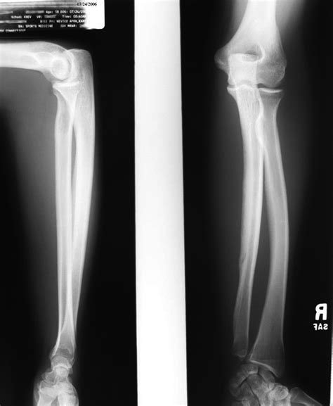 Ulna Hairline Fracture