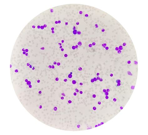 Chronic myeloid leukemia cells or cml, analyse by light microscope ...