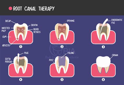 Root Canal Do They Put You To Sleep | Detroit Chinatown