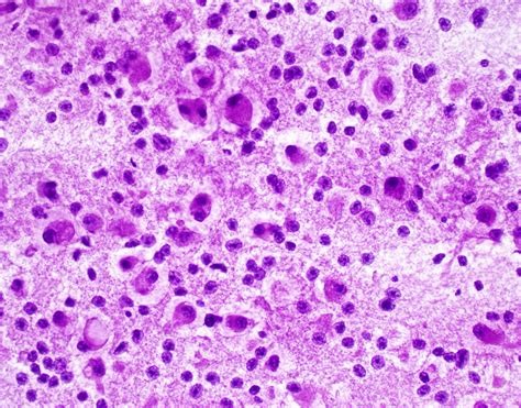 Pathology Outlines - Alveolar soft part sarcoma