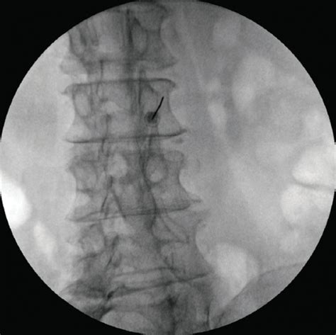 Does the severity of facet joint osteoarthritis affect facet medial branch radiofrequency ...