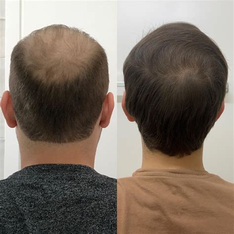 Finasteride Side Effects Reddit