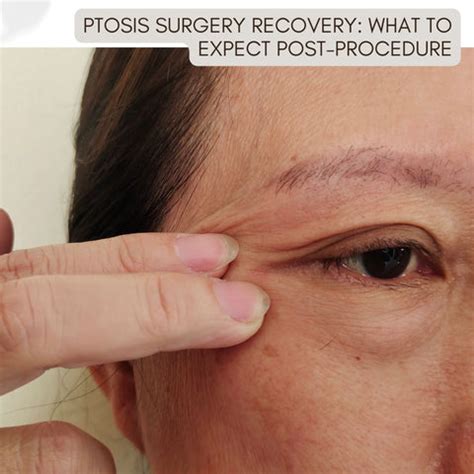 Droopy Eyelids (Ptosis): Causes, Treatments | Clinikally