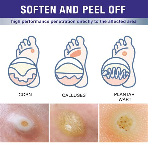 Plantar Wart Vs Common Wart at Walter Belin blog