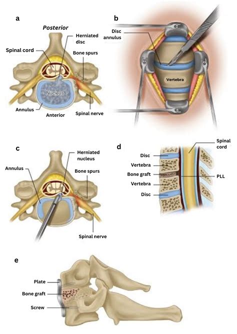 Anterior Cervical Discectomy & Fusion | SpineDRX