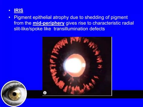 Pigment dispersion syndrome | PPTX