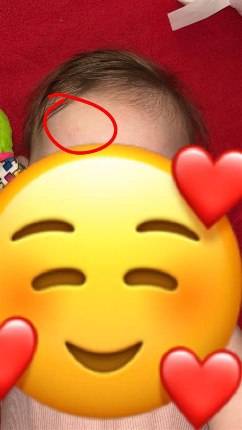 New angel kiss birthmark at 4 months??? : r/DermatologyQuestions