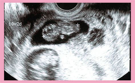 妊娠10週目で起こる母体の変化と赤ちゃんのエコーでわかるダウン症【医師監修】性別 35歳以下 結果 中絶率