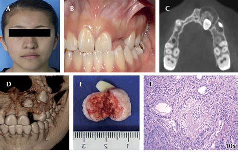 Adenomatoid odontogenic tumor. Presentation of 4 clinical cases and review of the literature.