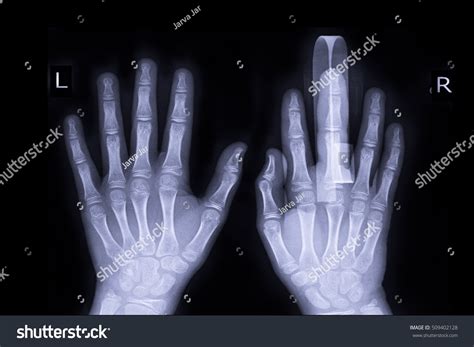 Broken Middle Finger