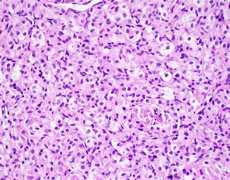 Pathology Outlines - Alveolar soft part sarcoma