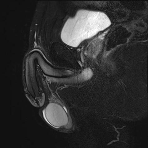 Testicular Cancer Signs Hydrocele at Rose Whipple blog - fluid in testicles
