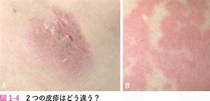 Image result for 皮疹
