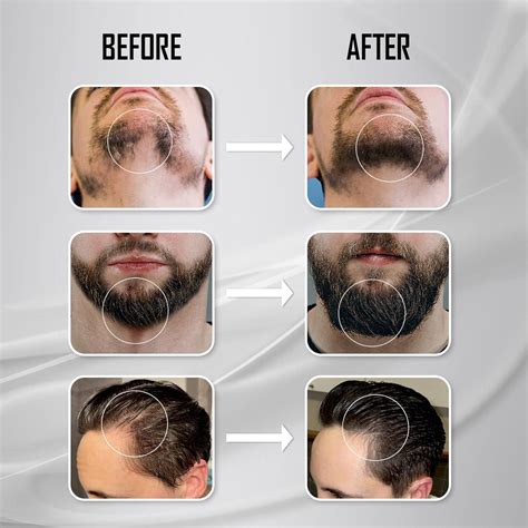 Derma Roller Kit for Face, Body, Hair & Beard Growth - 3 Pack Titanium Microneedle Rollers for ...