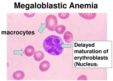 Megaloblastic Anemia - Causes, Symptoms, Treatment