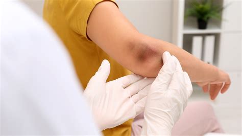Eliquis Medication Side Effects – KGZO