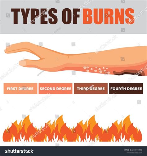Fourth Degree Burn Diagram