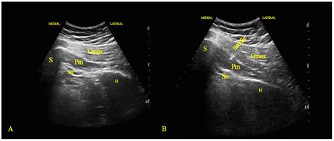 Piriformis Syndrome Ultrasound