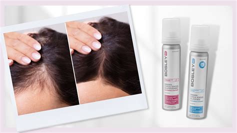 Topical Minoxidil for Hair Growth: How Exactly Does it Work? - Bella Pelle