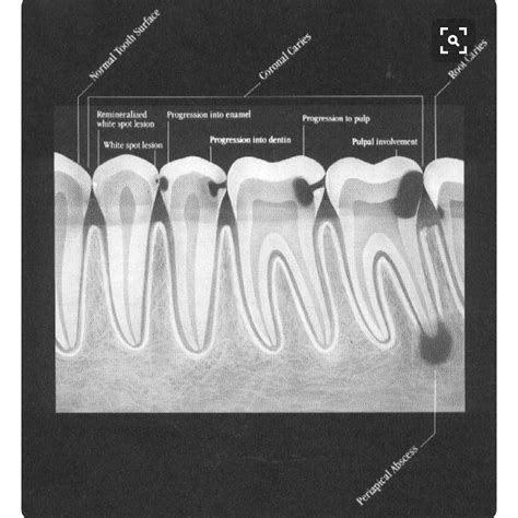 Tooth Decay X Ray