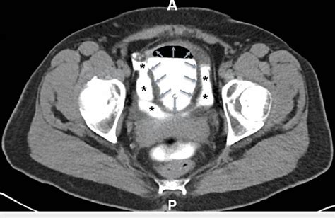 Image result for Cystogram Procedure for CT Scan