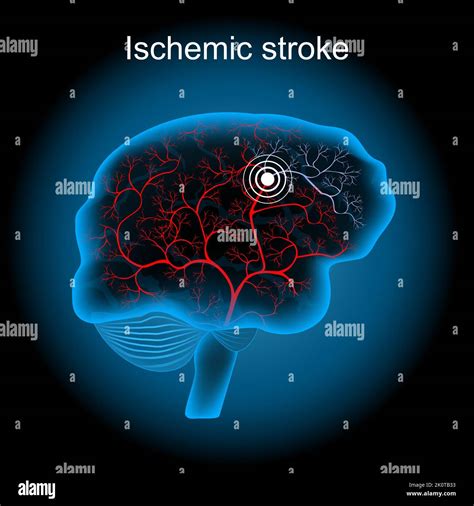 Ischemic stroke in the cerebral artery Stock Vector Images - Alamy