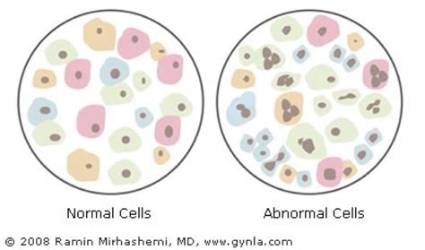 Abnormal Pap Smear — Ashley Irvin Public Health