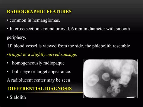Soft tissue calcifications of the oral cavity | PPTX