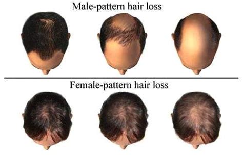 雄脱遗传吗？雄脱后能重新长出头发吗？还能治愈吗？_男性