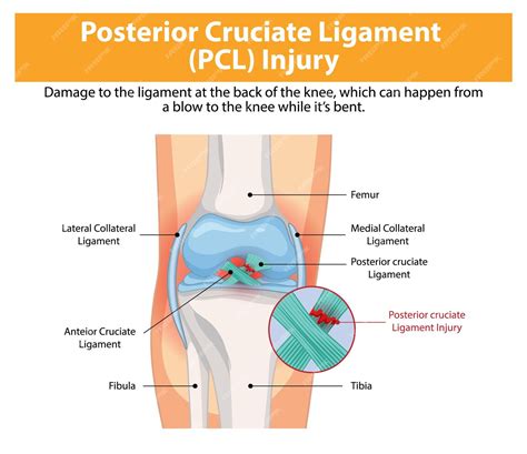 Free Vector | Posterior Cruciate Ligament PCL Injury