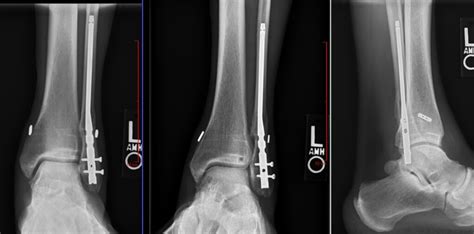 Ankle Fracture Surgery Patient Stories | Paul H Kim MD