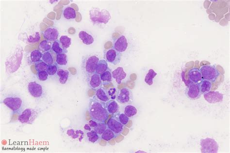 Acute Monocytic Leukemia Acute Myeloid Leukemia With