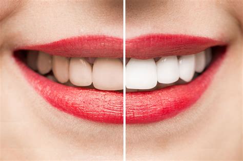 Teeth Whitening | Lister House Dental Centre | Essex Dentist
