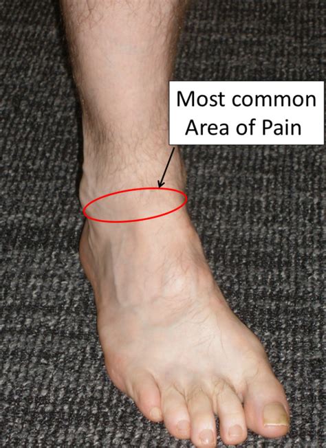 Anterior Ankle Impingement - FootEducation