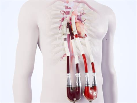 Berlin Heart Today Announces CE Approval and First Implantation of an ...