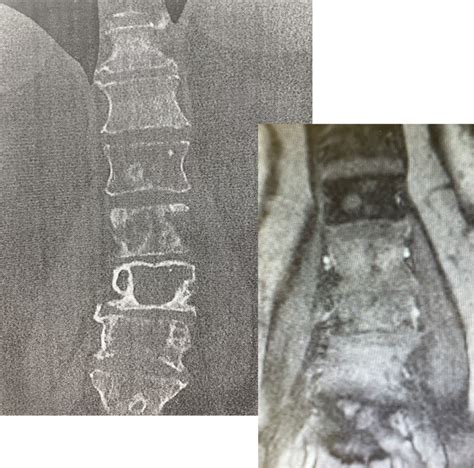 Tumor Metastasis L3 Posterior fixation L1 – L5 Alexander Franck, MD ...
