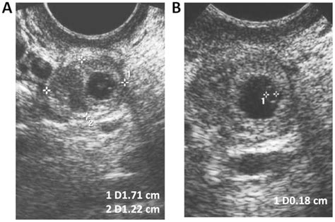 Methotrexate Injection For Ectopic Pregnancy